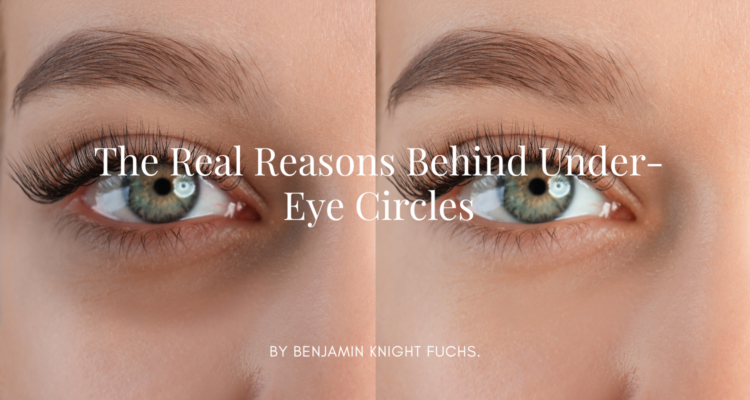 Why You Have Dark Circles—and What You Can Do About It