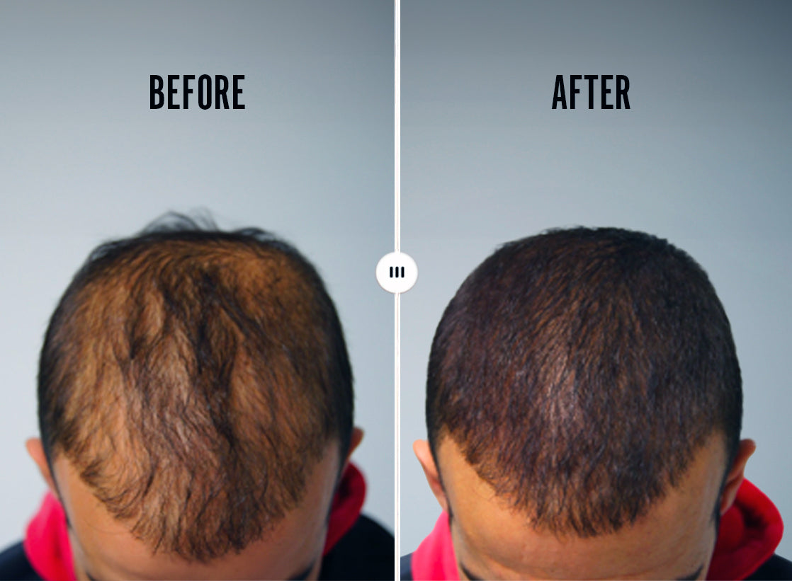 SCALP THERAPY - 90 DAY SUPPLY