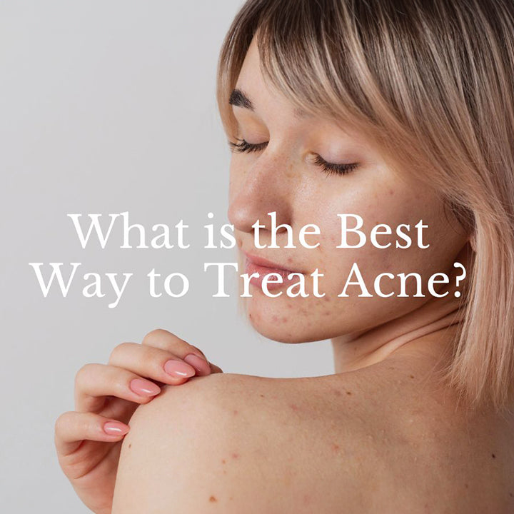What is the Best Way to Treat Acne?